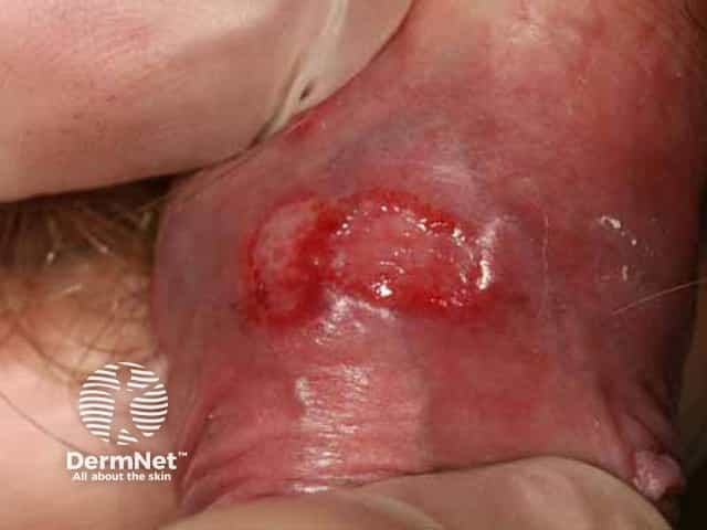 Herpes simplex of penis