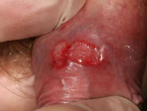 Herpes simplex of penis