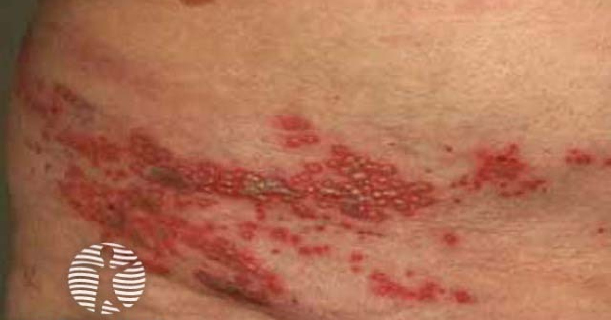 Herpes Zoster image