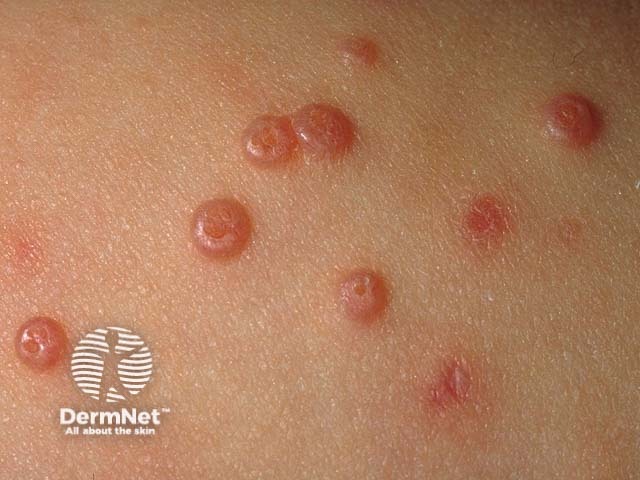 Typical umbilicated papules