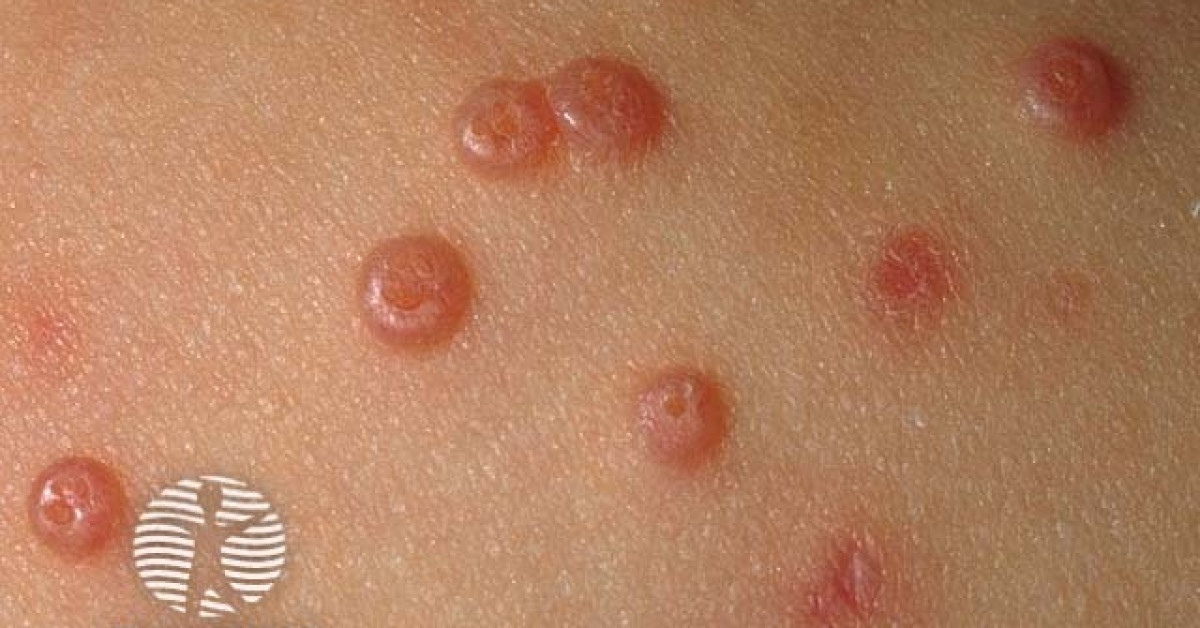 molluscum-contagiosum-image
