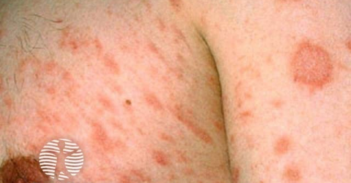 Rosette Rash Pityriasis rosea image