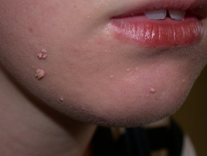verruca vulgaris face