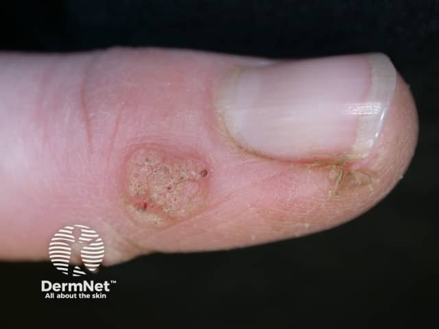 Verruca vulgaris on a thumb