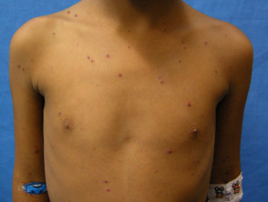 people with chickenpox