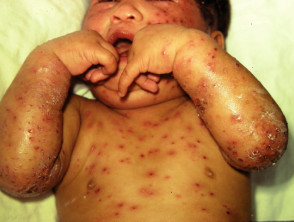 neonatal varicella