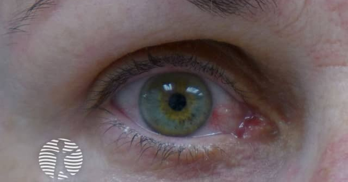 Zika virus infection image