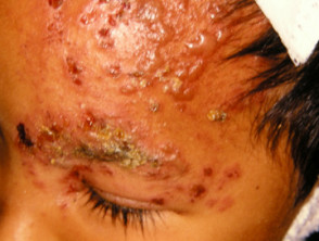 shingles rash on face