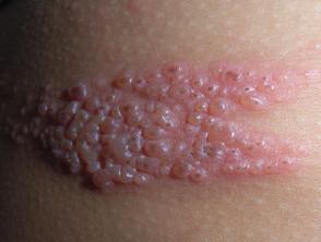 Herpes armpit lymph nodes