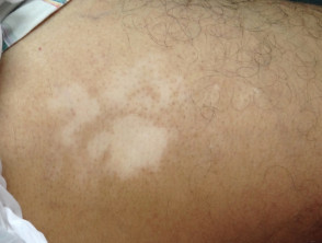 Vitiligo on the gluteal area