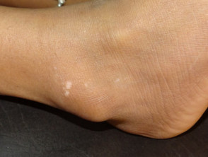 Vitiligo of the ankle