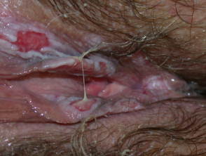 Vulval pemphigus vulgaris