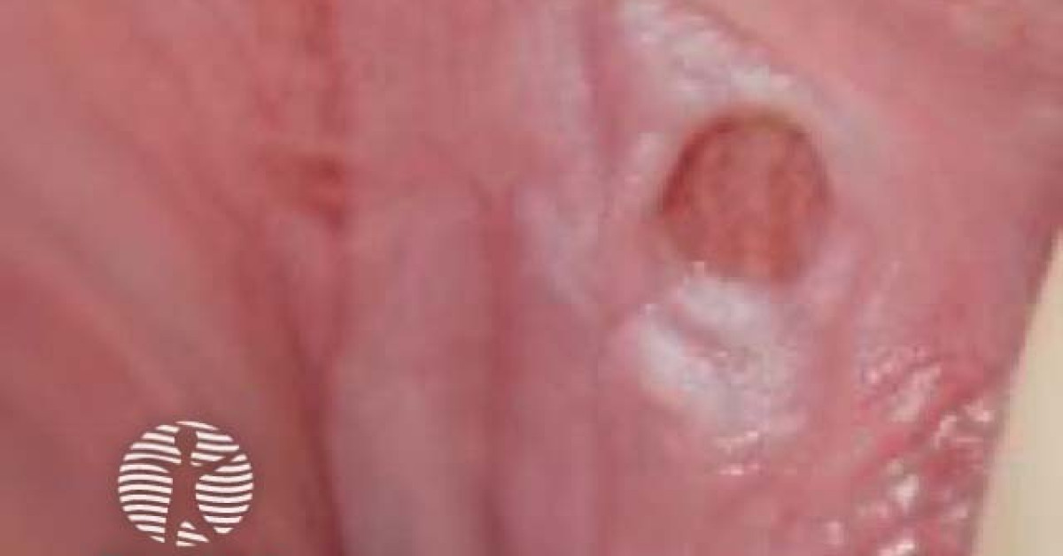 Vulval Ulcer Image vulval-ulcer-image