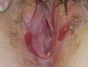 Vulval ulcer