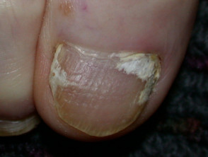Superficial white onychomycosis 1