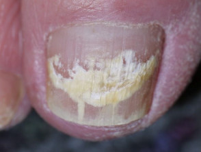 Superficial white onychomycosis 3