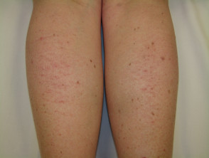 Apparently normal skin in a patient complaining of itchy legs
