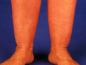 Dermatitis due to scratching at dry skin