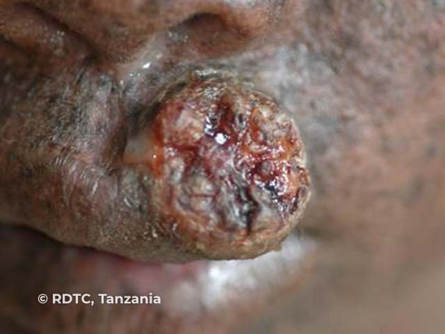 Squamous cell carcinoma on upper lip