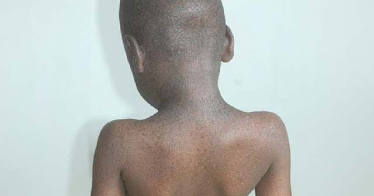 Xeroderma pigmentosum image