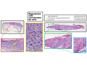 Histopathology of squamous cell carcinoma in situ