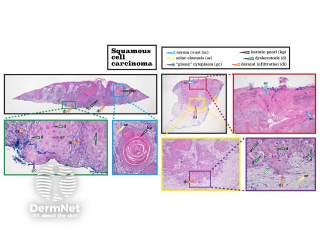 Histopathology of squamous cell carcinoma