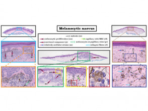 Histopathology of melanocytic naevus