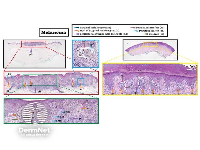 Histopathology of melanoma