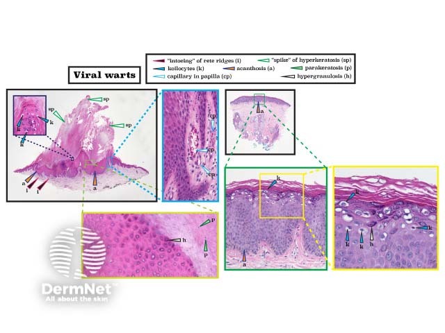 Histopathology of viral wart