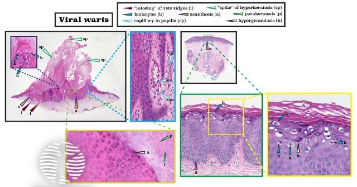 Dermnet® Histopathology Of Viral Wart Image