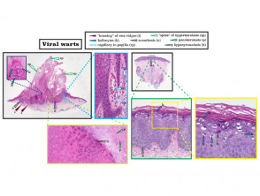 Histopathology of viral wart