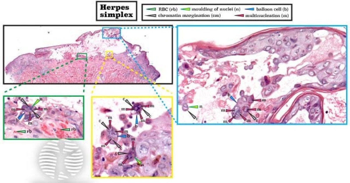 Histopathology of herpes simplex image