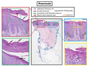 Histopathology of psoriasis