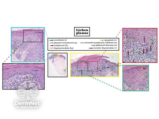 Histopathology of lichen planus