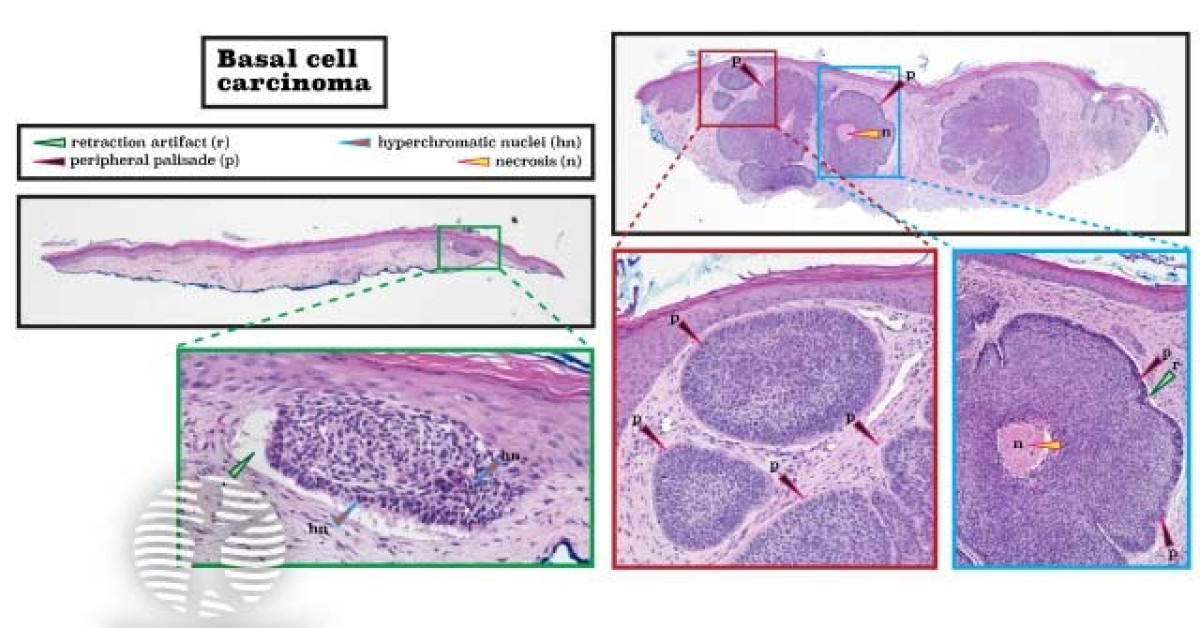 Histopathology of basal cell carcinoma image