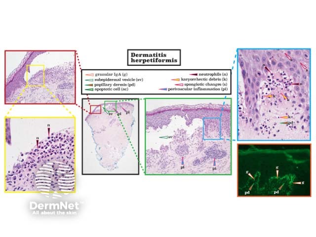Histopathology of dermatitis herpetiformis