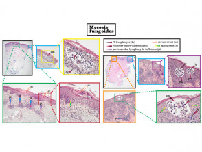 Histopathology of mycosis fungoides