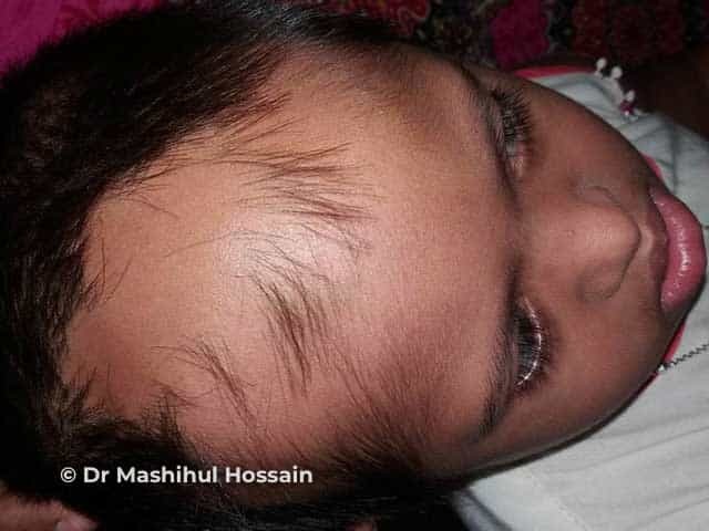Alopecia areata: scalp
