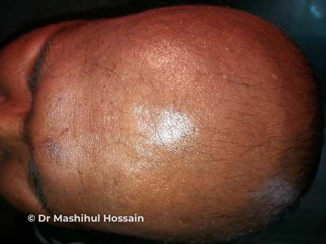 Alopecia totalis