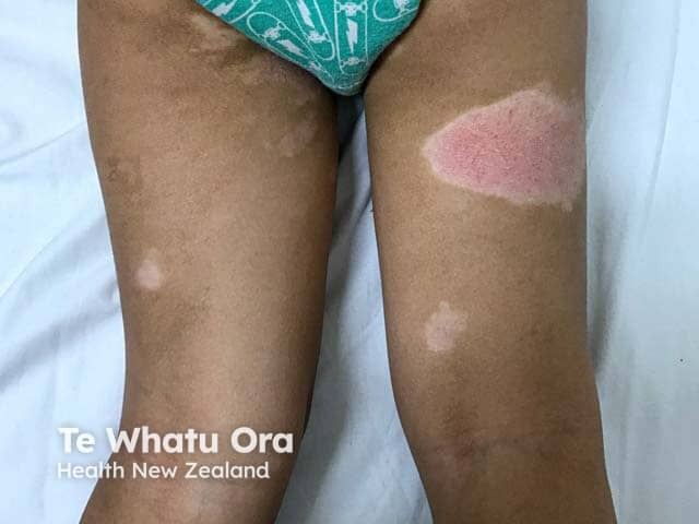 Atopic dermatitis with dyspigmentation in young child with skin of colour