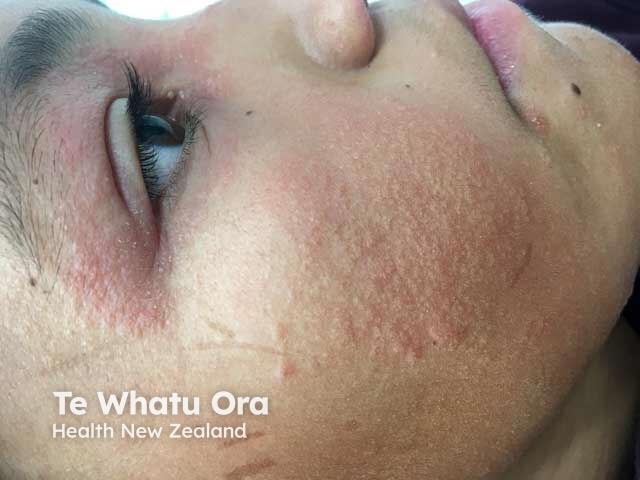 Face and eyelid atopic dermatitis in a child