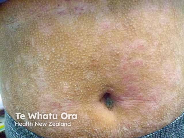 Papular atopic dermatitis with post-inflammatory hypopigmentation in teenager with skin of colour