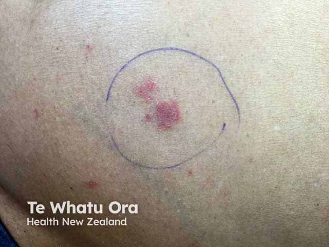 Patches of atopic dermatitis in skin of colour