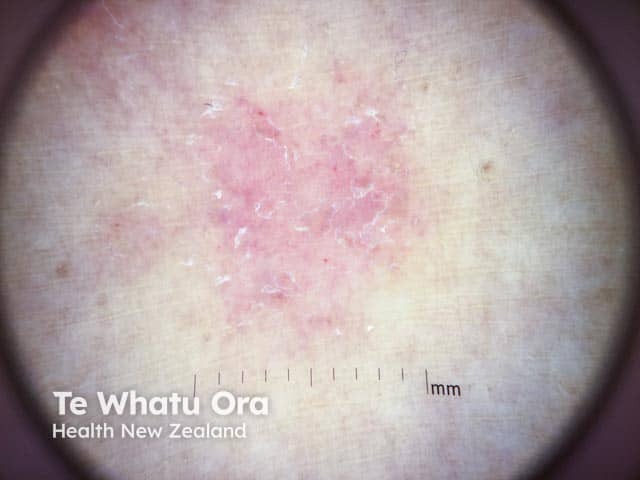 Focal white scale and patchy dotted vessels on dermoscopy