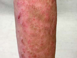 Atopic dermatitis with dyspigmentation in child with skin of colour
