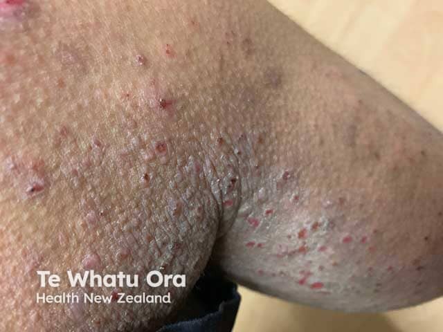 Excoriated lichenified papular atopic dermatitis in a teenager with skin of colour