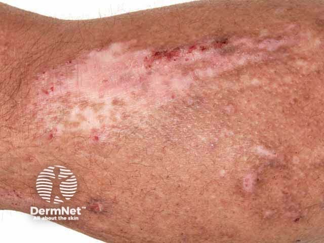 Leukoderma in lichenified atopic dermatitis