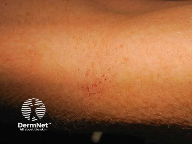 Brachioradial pruritus, forearm early excoriations