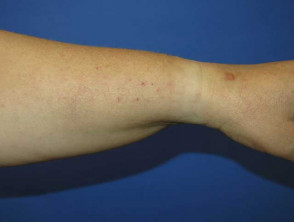 Brachioradial pruritus, forearm secondary skin changes