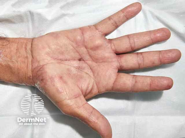 Palmar changes of bullous pemphigoid in skin of colour